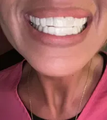Shiny Smile Veneers 4