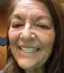 Shiny Smile Veneers 6